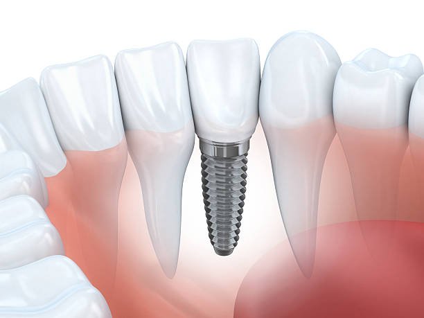 dental implants in HSR Bangalore
