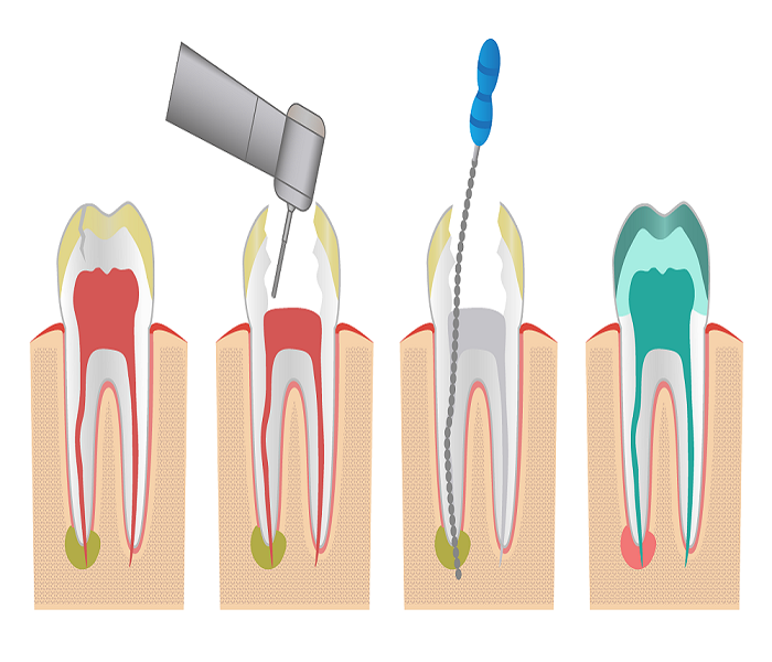 root canal treatment in Bangalore